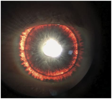 Iris Transillumination Defects In Pigment Dispersion Syndrome Nejm