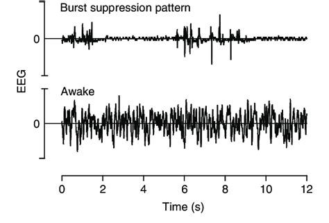 Eeg Pattern Difference Between Burst Suppression Top And Awake