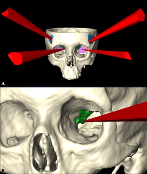 The 3d Reconstructions In A Ventral Perspective Of The Surgical Freedom