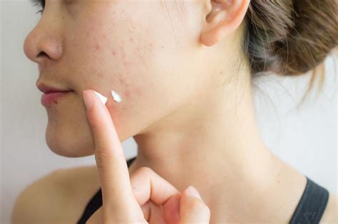 how to get rid of acne scars treatments and home remedies elegancy beauty bar