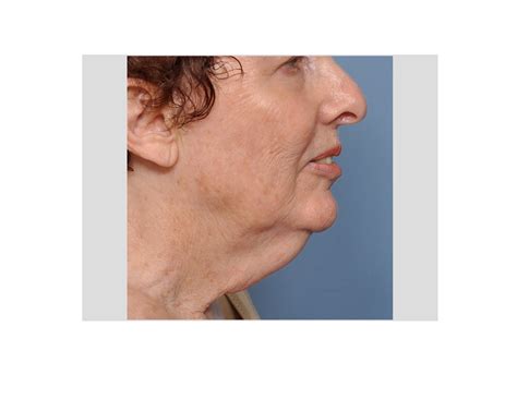Case Study The Direct Necklift For Female Neck Wattles Explore