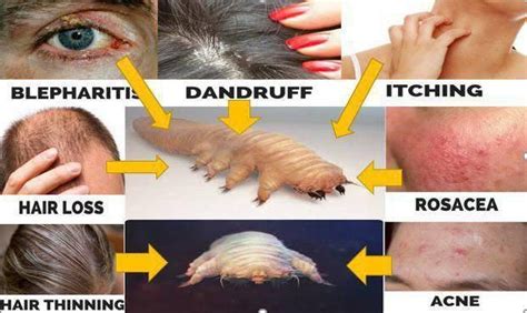 90 Amazing What Are Demodex Mites In Humans Insectza