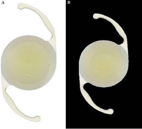 A Diffractive Trifocal Toric Intraocular Lens Panoptix Toric B Download Scientific Diagram