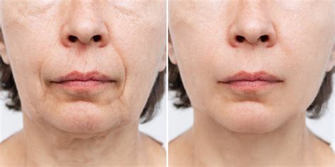 How To Get Rid Of Sagging Jowls 5 Proven Methods