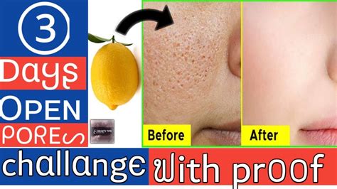 Open Pores Treatment Naturally At Home How To Get Ride Of Open Pores
