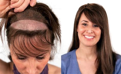 Non Surgical Hair Transplant For Women At The Hair Clinic Montreal