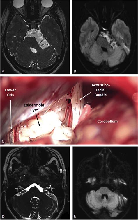 Illustrative Case Of A Cerebellopontine Angle Epidermoid Cyst Operated