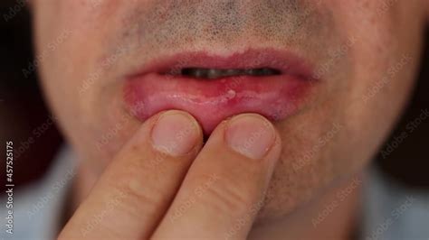 Recurrent Aphthous Ulcers Or Canker Sores Sore Lip Aphthous Stomatitis Benign And Non