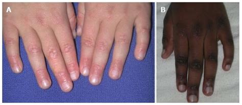 Review Of The Cutaneous Manifestations Of Autoimmune Connective
