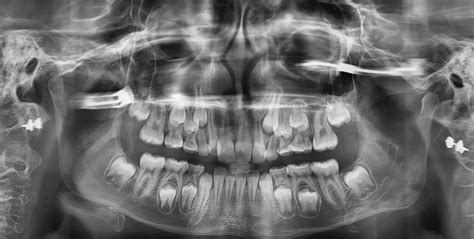 Others recommend that they get baby teeth xray as often as convincing, which would be dictated by your pediatric dentist. Dental X-rays: Why are they necessary at an orthodontic visit?