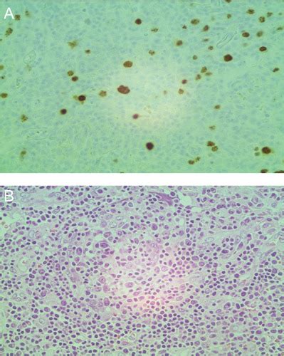 A Left Supraclavicular Lymph Node Hhv8 Infected Plasma Cells In