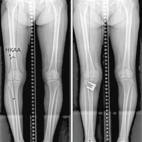 Hip Knee Ankle Angle Hkaa Measurement Method And Correction Of Varus