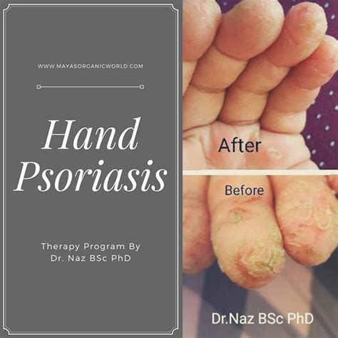 Hand Psoriasis Mayas Organic World