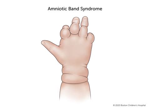 Amniotic Band Syndrome Boston Childrens Hospital