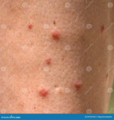Allergic Rash Dermatitis Leg Skin Stock Photo Image Of Caucasian