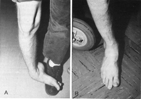 Surgical Correction Of Spastic Equinovarus Deformity In The Adult Head