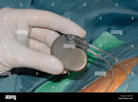 Pacemaker Implantation Stock Photo Alamy