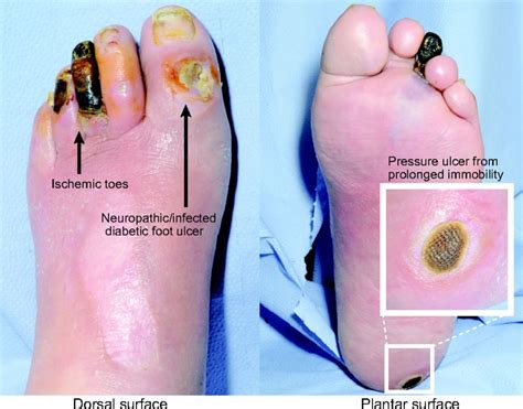 Diabetic Foot Ulcers Symptoms Causes And Treatment Diabetes Health My