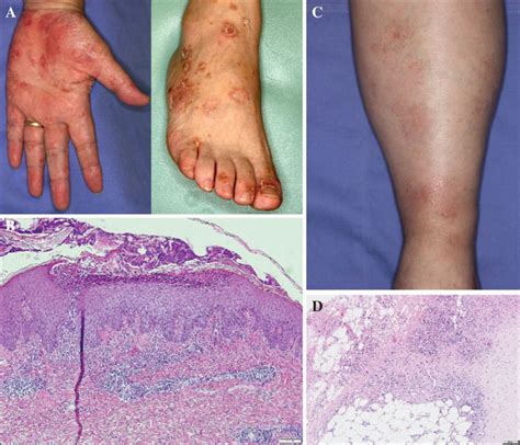 Jle European Journal Of Dermatology Tnf α Inhibitor Induced