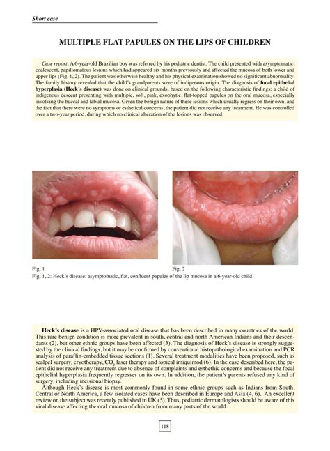 Pdf Multiple Flat Papules On The Lips Of Children