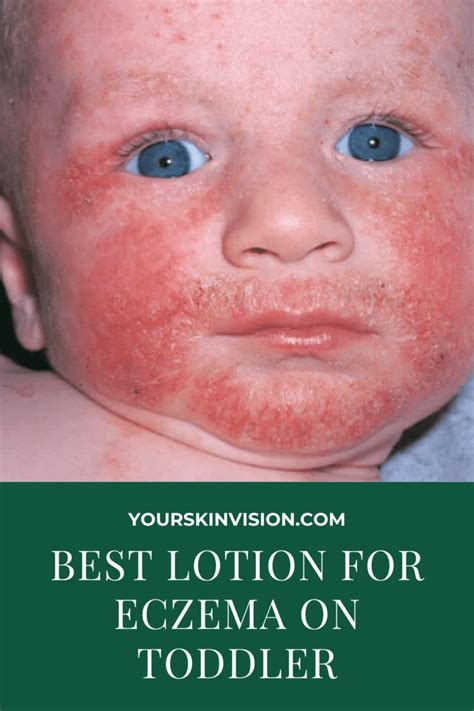 5 Best Lotion For Eczema On Toddler In 2023 Yourskinvision
