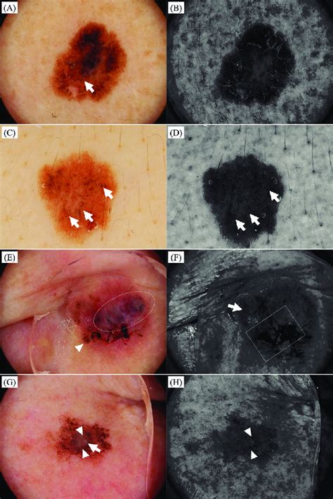 Representative Dermoscopic Images Of Pigmented Skin Tumours A And B