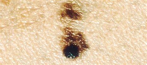 Combination Approach Shows Promise For Beating Advanced Melanoma