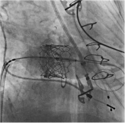 Still Frame Of Transcatheter Mitral Valve Replacement Implantation