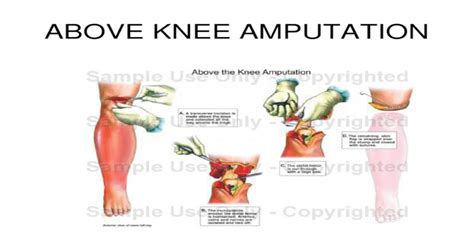 Above Knee Amputation Ppt Powerpoint