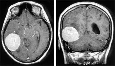 Tumores cerebrales Qué hay que saber Dr Louis Valery Carius Estrada