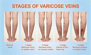 Varicose Veins Specialist - New Port Richey, FL: Satish Sivasankaran, MD., MRCP(UK)., FACC., MBA ...  Heart and Circulation Varicose Veins