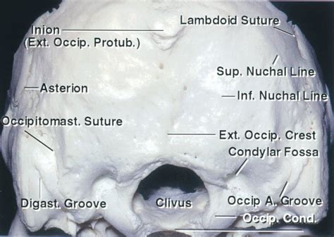 Suboccipital Craniotomy The Neurosurgical Atlas By Aaron Cohen Gadol