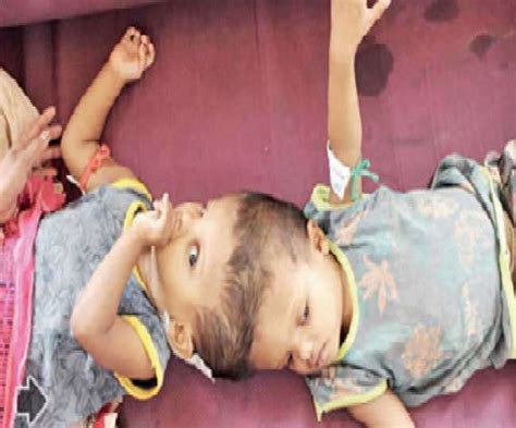 एम्‍स के डॉक्टरों का कमाल सिर से अलग किए गए जुड़वा बच्चों के सिर Ncr Odisha Twins Separated