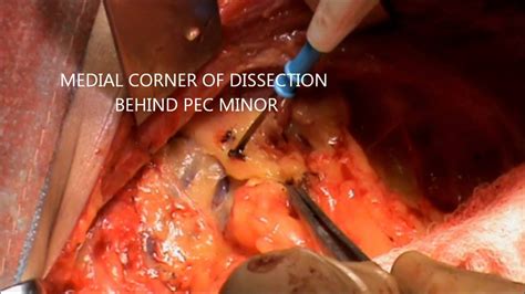 Axillary Dissection During Mrm Electrosurgery Video Dr Rajnish Talwar