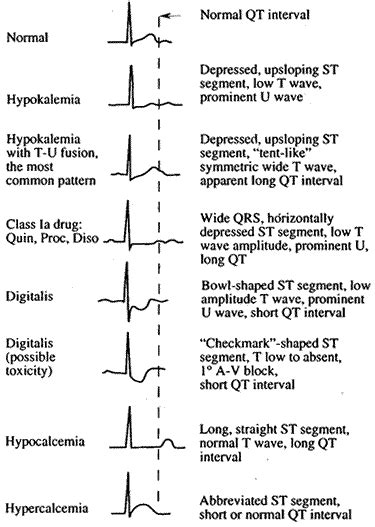 Ekg Changes With Electrolyte Abnormalities Nursing Mn