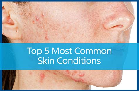 Top 5 Most Common Skin Conditions Avail Dermatology