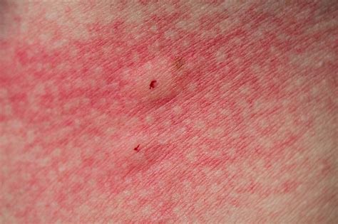 How To Identify Bed Bug Bites