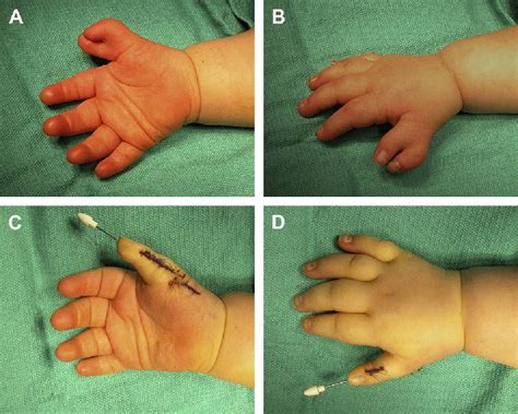 Congenital Hand Differences Aura Plastic Surgery