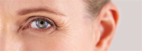 Crows Feet 卵 Heres What You Can Do About Eye Wrinkles