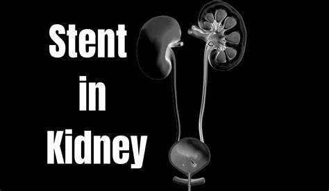What You Need To Know About Stent In Kidney