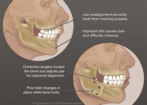 Corrective Jaw Surgery In Tucson Az Schumer Dental Pc