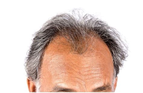 Hair Loss Spiritual Cause Meaning And Healing Insight State