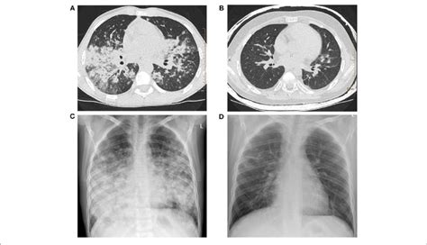 A Lung High Resolution Computed Tomography Hrct Multiple Poorly