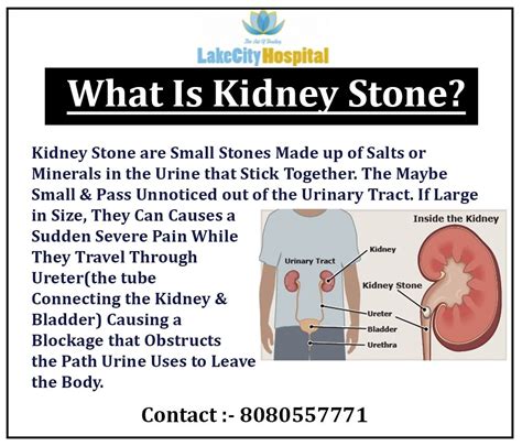 What Is Kidney Stone For Information Contact 8080557771 Urologist