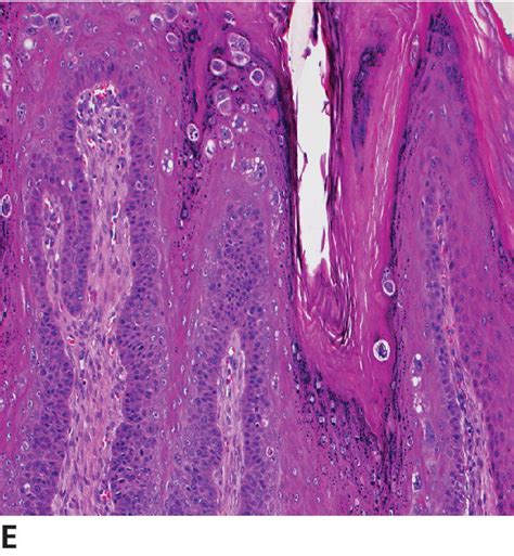 Epithelial And Melanocytic Tumors Of The Skin Veterian Key