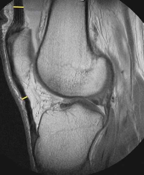 Sagittal Mri Sequence Of A Knee With An Acl Tear Abbreviations Acl