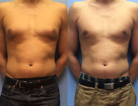 Quick Facts To Know About Gynecomastia Cosmetic Surgery Harley Body
