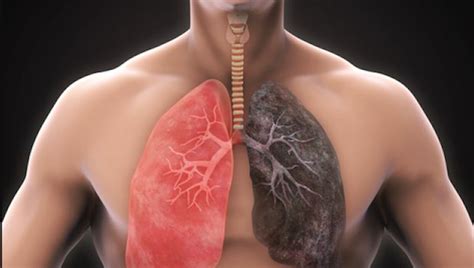 What Patients With Interstitial Lung Disease Should Know Elg Law