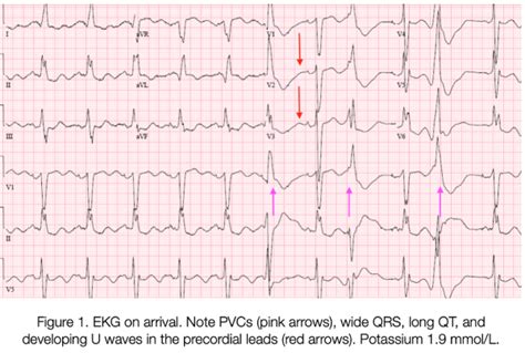 Hypokalemia Ecg