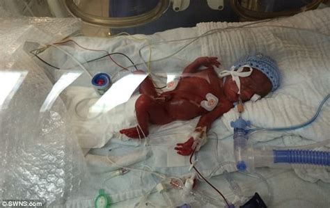 Premature Twins Born At 24 Weeks Were Given No Chance Of Surviving But